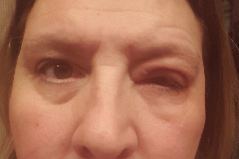 Fundraiser by Semone DeVore Magill HELP ME SAVE MY EYE