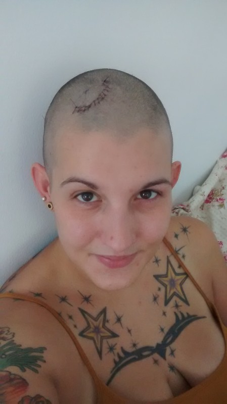 Hair Cuts To Cover Up Brain Surgery | hair cuts to cover up brain surgery hair cut after brain Hair Cuts To Cover Up Brain Surgery | hair cuts to cover up brain surgery hair cut after brain